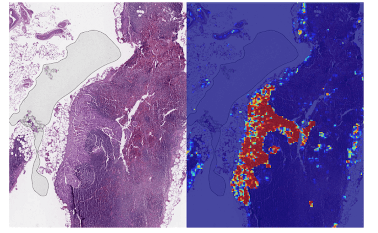 AI-based tools assist in detecting cancer example